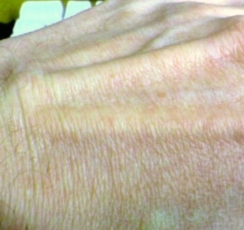 THE FINELY-WRINKLED SKIN ON THE TOP OF MY HAND. This virus causes finely-wrinkled skin to appear on the hands and all over the body, with the wrinkles having a crêpe paper-like appearance.
